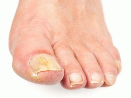 Nail damage with foot fungus