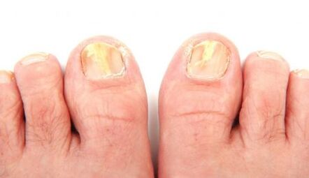 toenail fungus manifestations