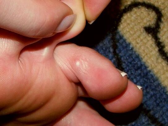 toe fungus symptoms