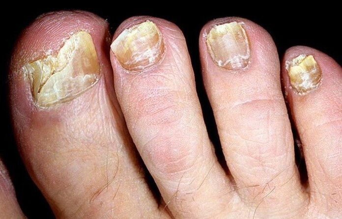 nail fungus