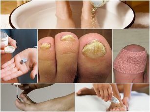 Treatment of nail fungus