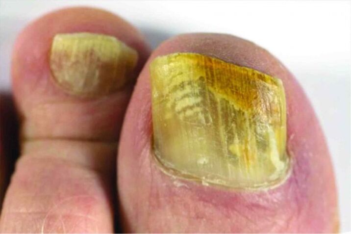Nail feeling in the leg