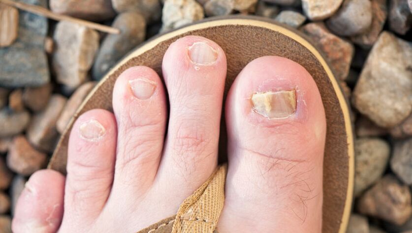 Nail onicomicosis