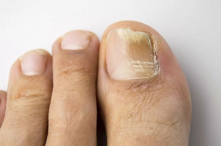 Nail ringworm in the leg